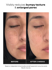Niacinamide 20% Treatment