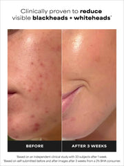 2% BHA Exfoliating Toner Duo